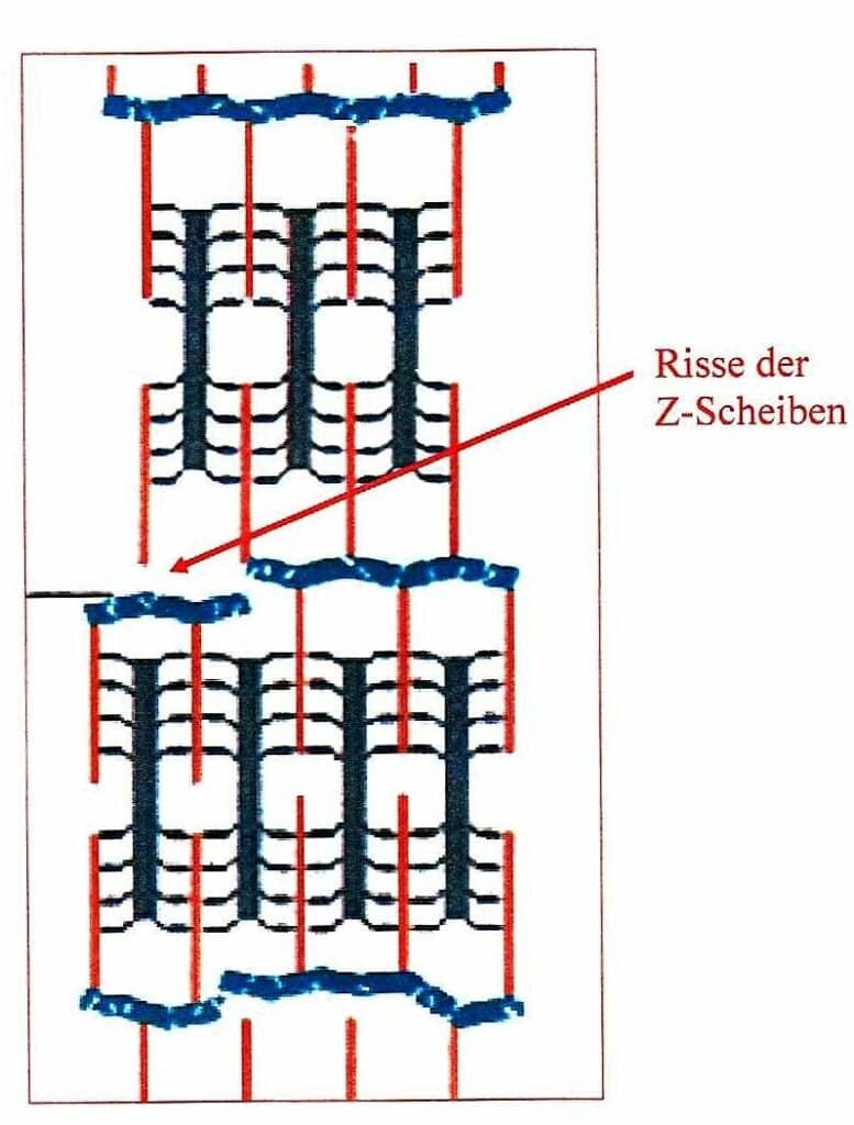 Schwimmlexikon-Muskelkater